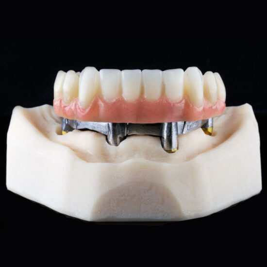 Implants – German Zahn Dental Lab