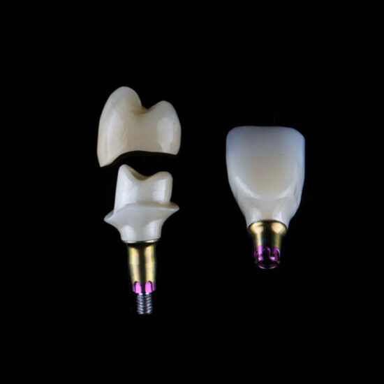 Implants German Zahn Dental Lab