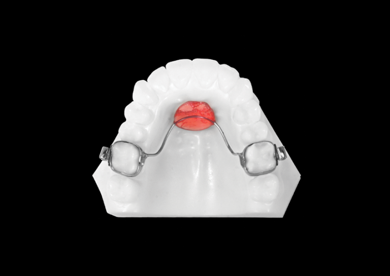 Maxillary Removable Bilateral Space Maintenance (Nance Appliance